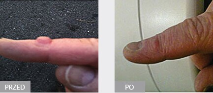 Terapia ENF torbieli palca wskazującego