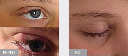 Terapia ENF gradówki górnej powieki prawego oka